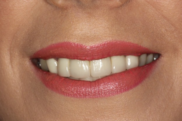 Veneers For A New Smile Bounty Road Dental Practice